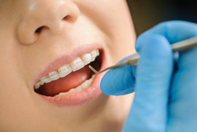 Affordable Braces treatment in Singapore options and insurance coverage