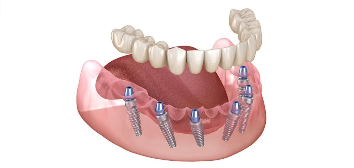 Understanding Bone Health: The Foundation of Successful Dental Implants