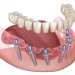 Understanding Bone Health: The Foundation of Successful Dental Implants