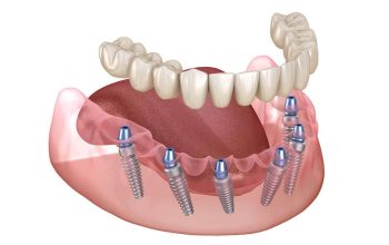 Understanding Bone Health: The Foundation of Successful Dental Implants