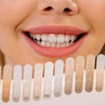 Veneers: The Silent Revolution in Dental Restoration Techniques