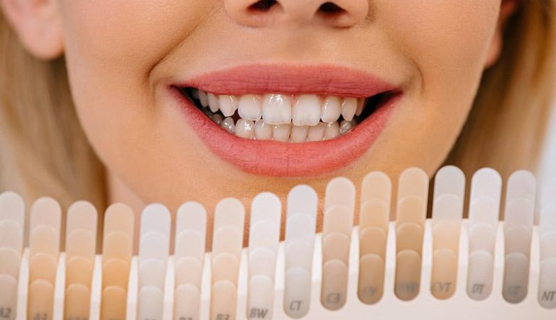 Veneers: The Silent Revolution in Dental Restoration Techniques