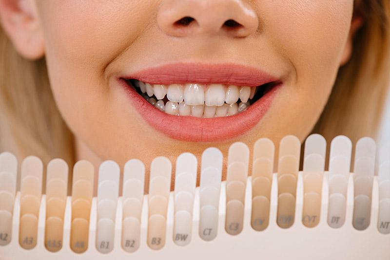 Veneers: The Silent Revolution in Dental Restoration Techniques