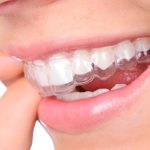 Why Invisalign Aligners Minimise Soft Tissue Irritation Throughout Your Orthodontic Journey