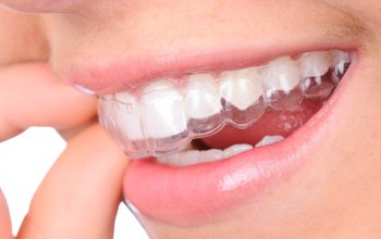 Why Invisalign Aligners Minimise Soft Tissue Irritation Throughout Your Orthodontic Journey