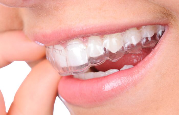 Why Invisalign Aligners Minimise Soft Tissue Irritation Throughout Your Orthodontic Journey