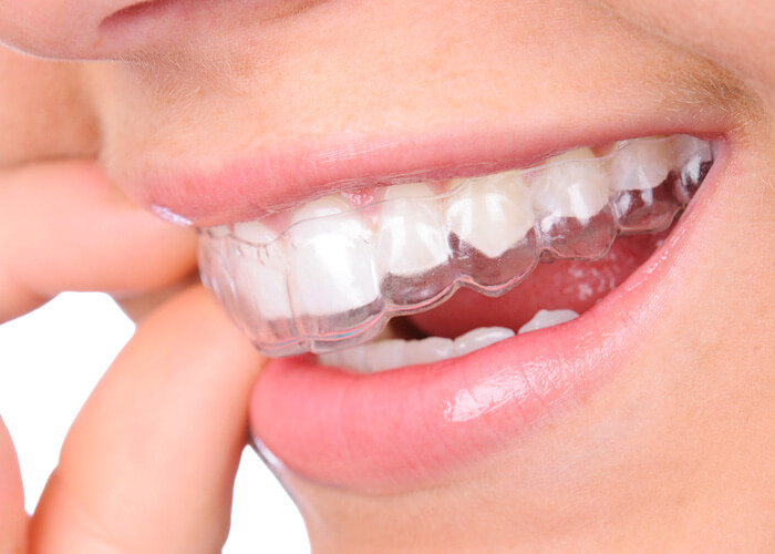 Why Invisalign Aligners Minimise Soft Tissue Irritation Throughout Your Orthodontic Journey